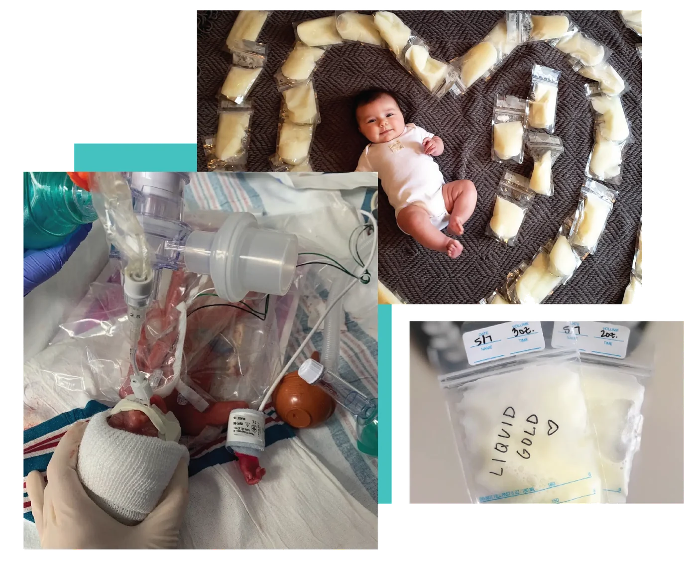 A baby lying among bags of donated breast milk, a premature infant receiving respiratory care in a NICU, and a labeled milk storage bag